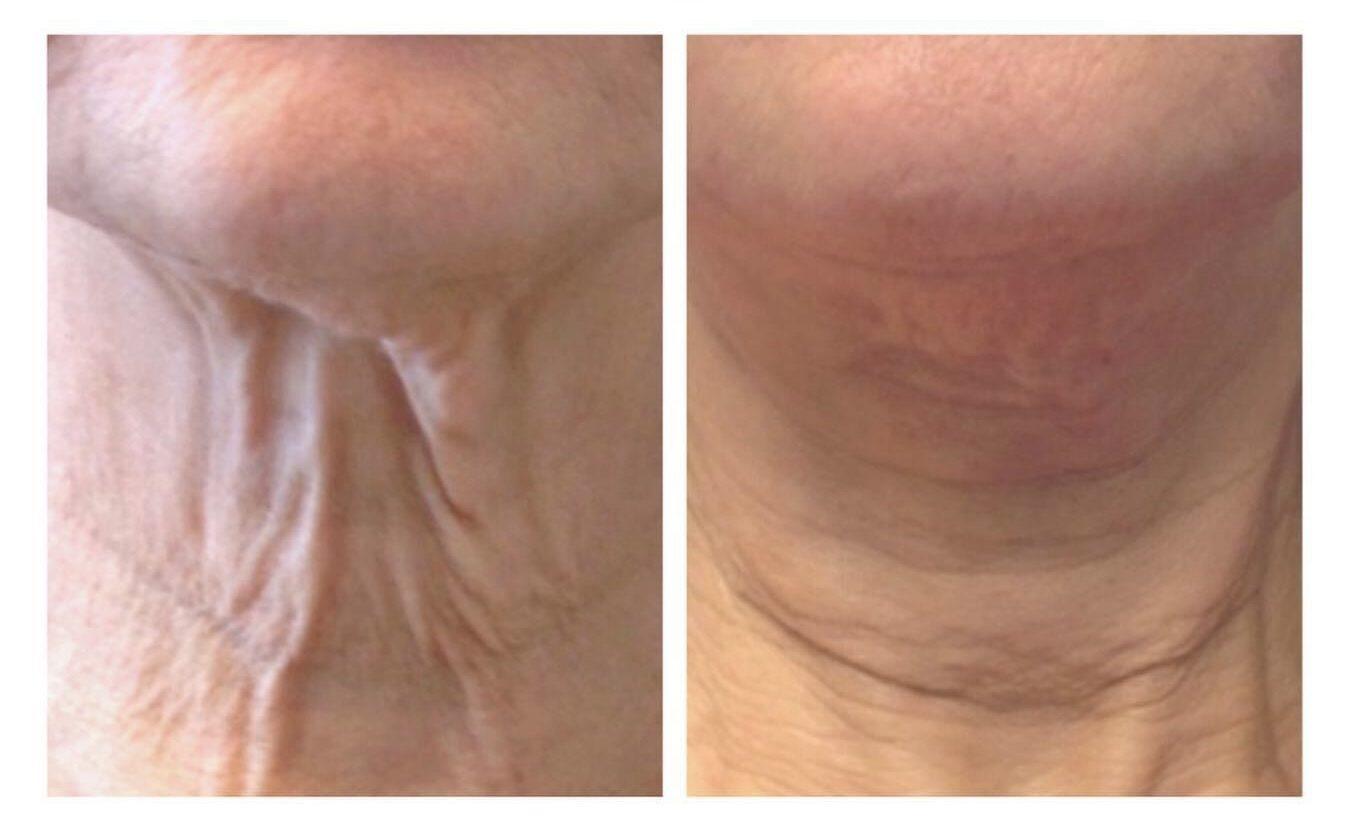 patient before and after Secret RF microneedling treatments