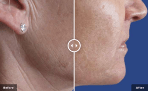 patient before and after Secret RF microneedling treatments